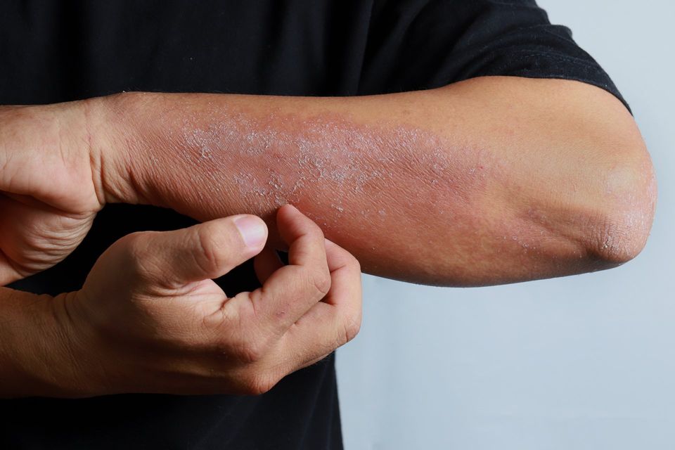 Dry Rashes Eczema/Dry skin – EPF Dermatology